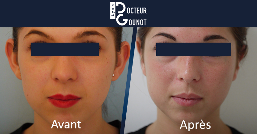 Otoplastie à Lyon : chirurgie esthétique des oreilles décollées